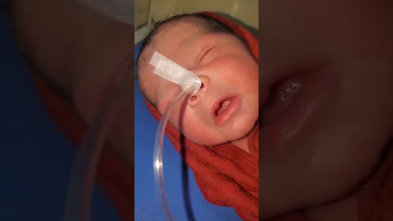 Newborn baby is fast breathing in dangerous and doctor take care of it and his mouth open
