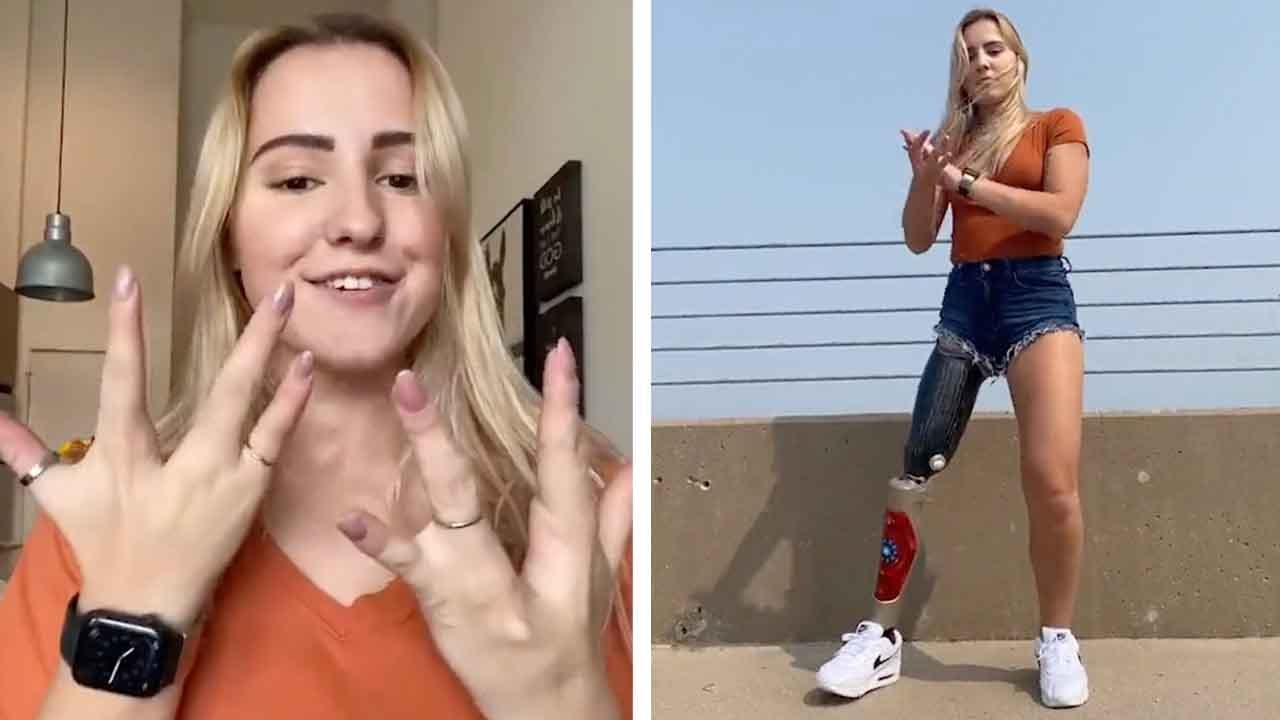 Female Amputee Gives Insight Into Living With Ectrodactyly