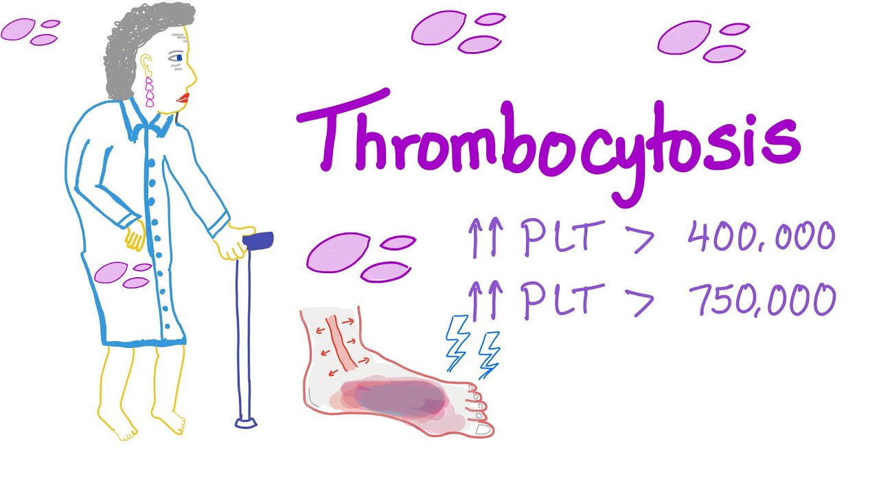 Thrombocytosis (Primary and Secondary) - Why Is My Platelet Count High? - Hematology