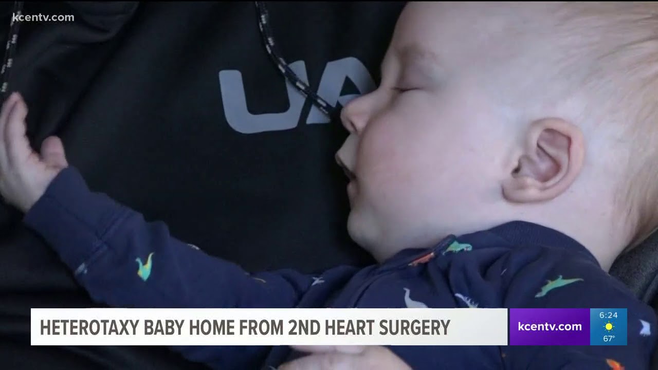 Heterotaxy baby home from 2nd heart surgery
