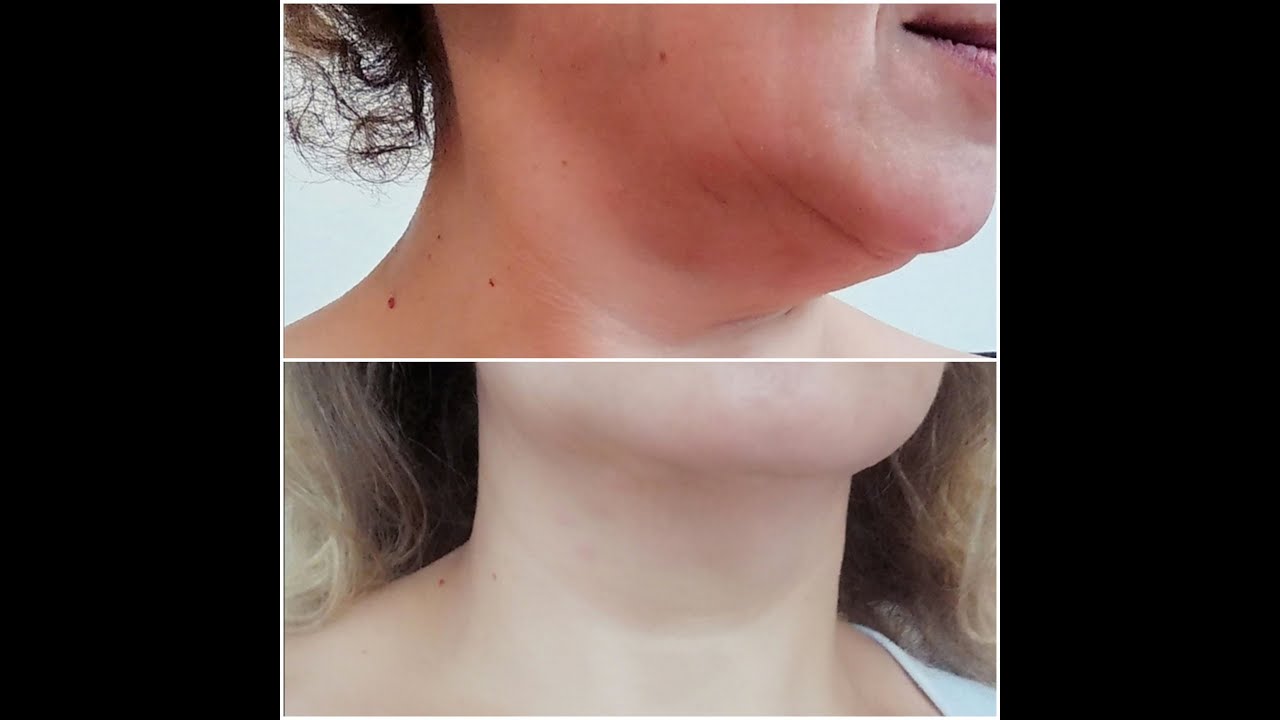 Comment éliminer le double menton et corriger l'asymétrie du visage? Les soldes continuent;)