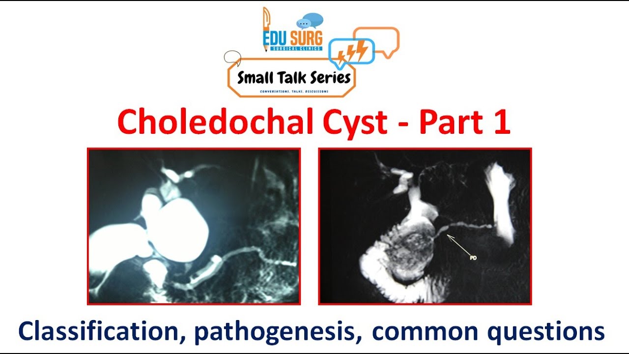 Choledochal cyst - Classification, Pathogenesis, recent advances, risk of cancer - Edusurg Clinics