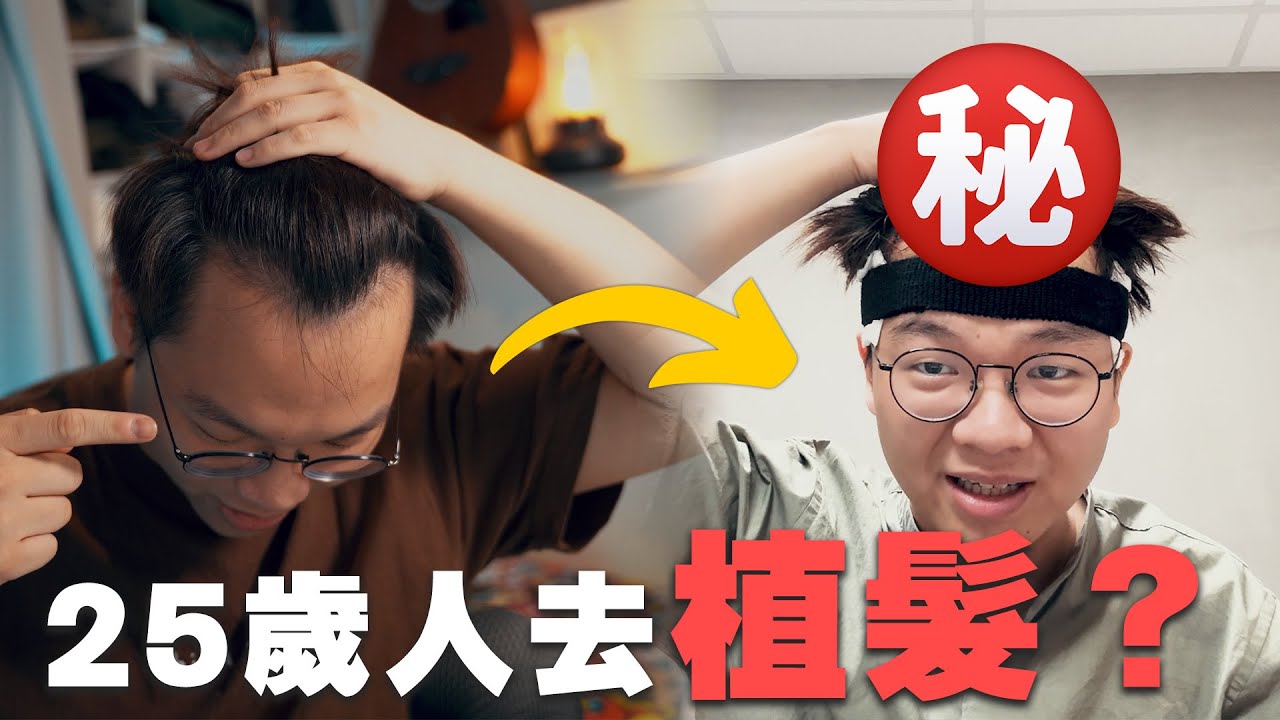 25歲的年輕人決定去植髮，只為了做一件事！【植髮一個月全紀錄】