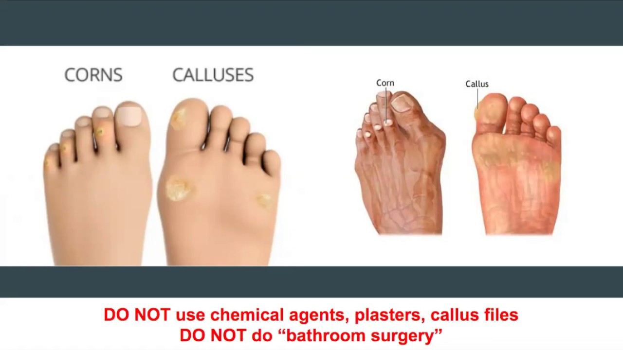 Diabetes Foot Care Guidelines