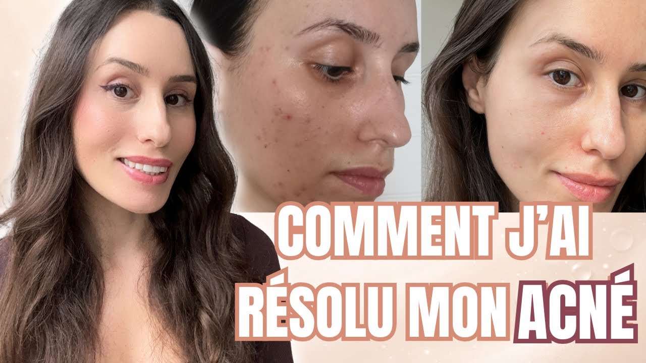 Ma routine anti-acné ultime (acné adulte, boutons persistants, marques)
