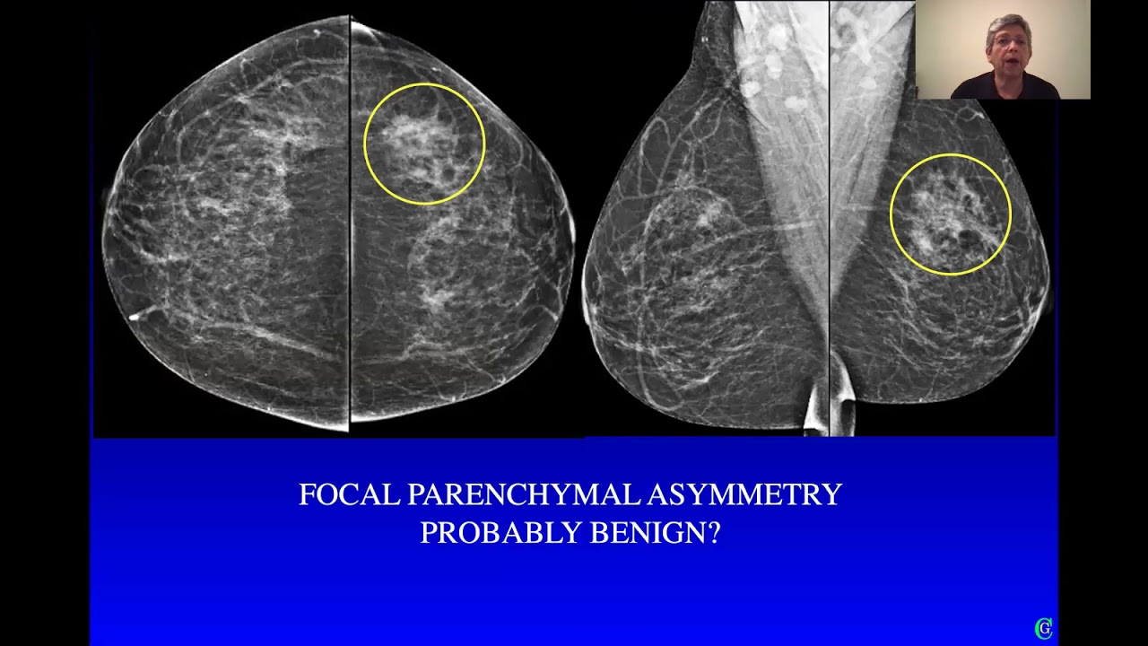 The probably benign lesion: definition, evaluation and management