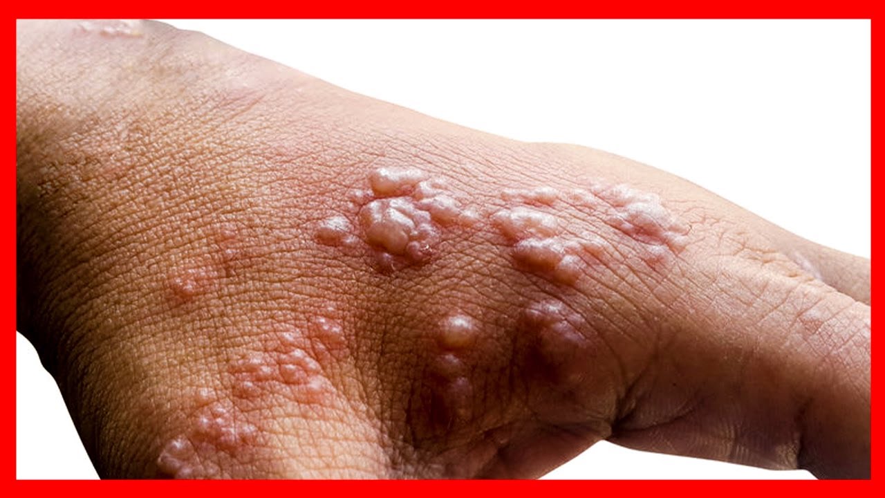 Mu Rwanda hamaze kugaragara abantu babiri barwaye indwara y'ubushita bw'inkende (Monkeypox)