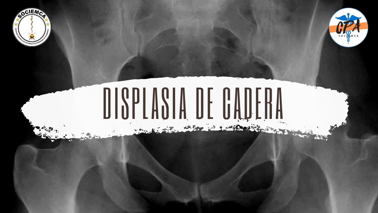 Displasia de Cadera