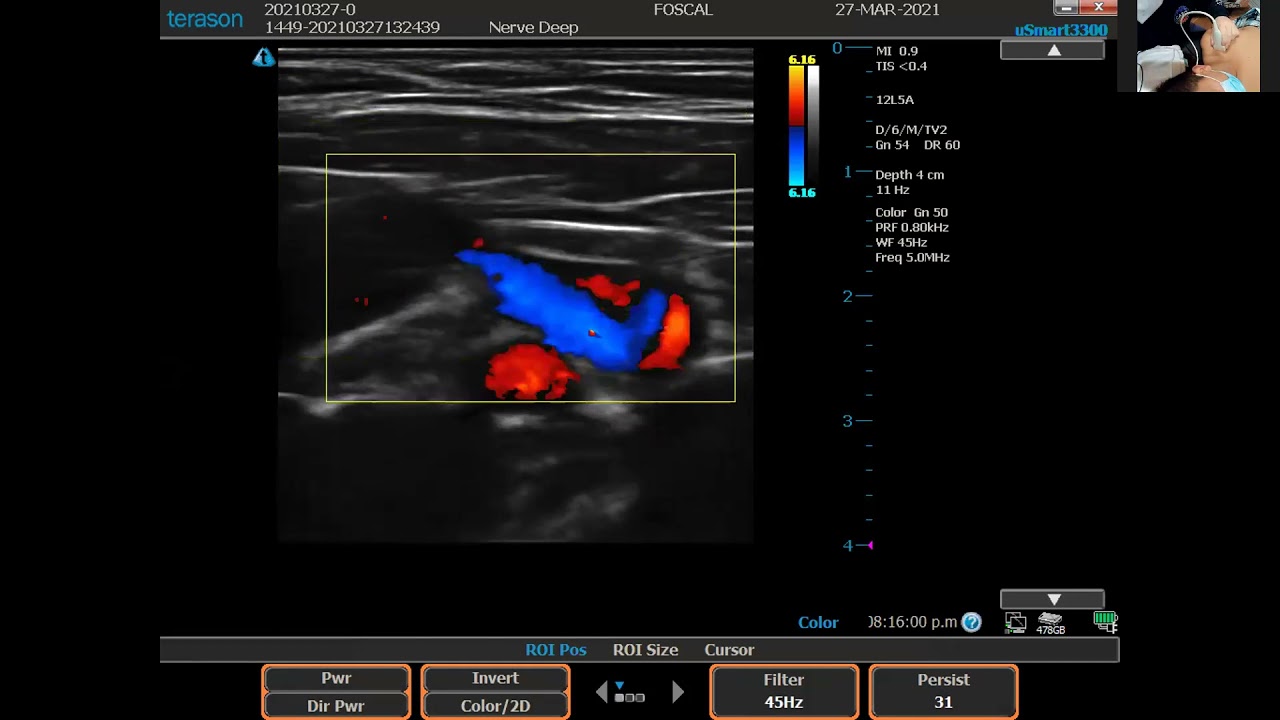 ESCANEO INFRACLAVICULAR DEL PLEXO BRAQUIAL