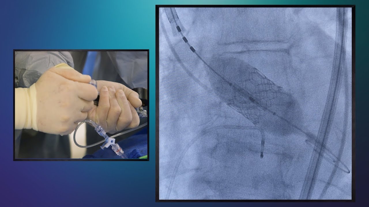 Transcatheter Aortic Valve Replacement (TAVR) &ndash; Essentia Health