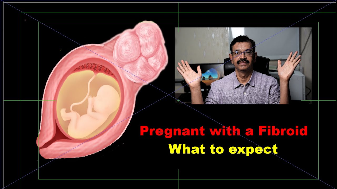 Pregnant with fibroid 