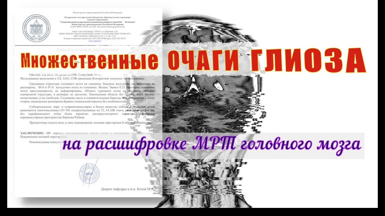 Множественные ОЧАГИ ГЛИОЗА в белом веществе лобных и теменных долей на расшифровке МРТ мозга