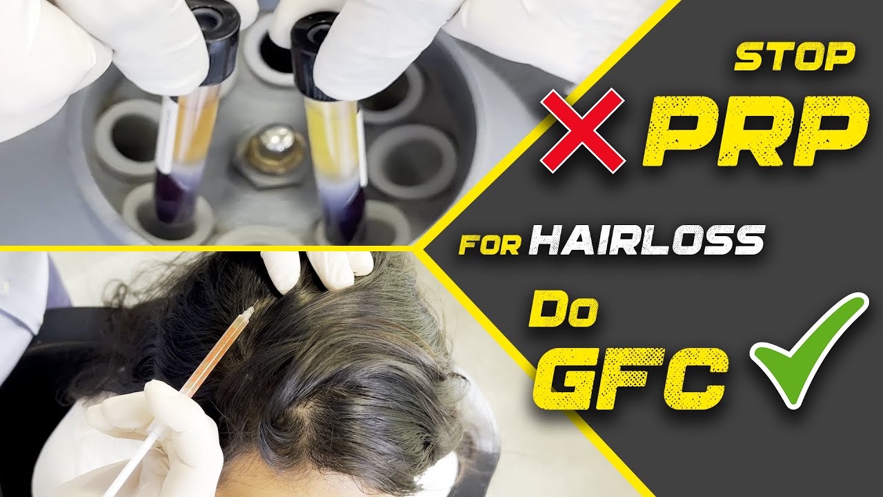 5 Reasons Why GFC is Better than PRP | Treatment for Hair loss | GFC Hair Treatment in India, Mumbai