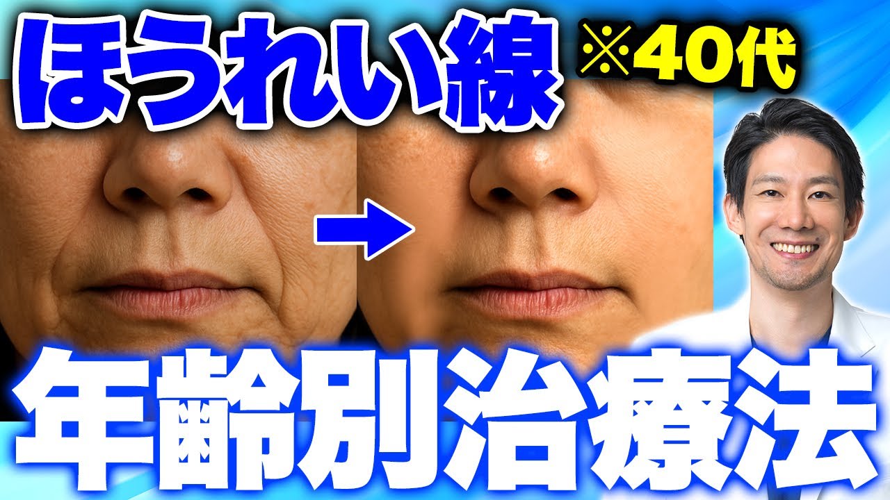 【医師が教える】ほうれい線は年齢で治療法が違います！年代別ベスト治療【ほうれい線/40代】