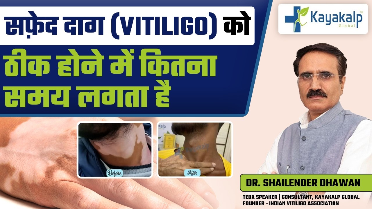 Finger Tips & Lips पर सफ़ेद दाग क्यों Dangerous है? | Vitiligo Warning Signs | Kayakalp Global