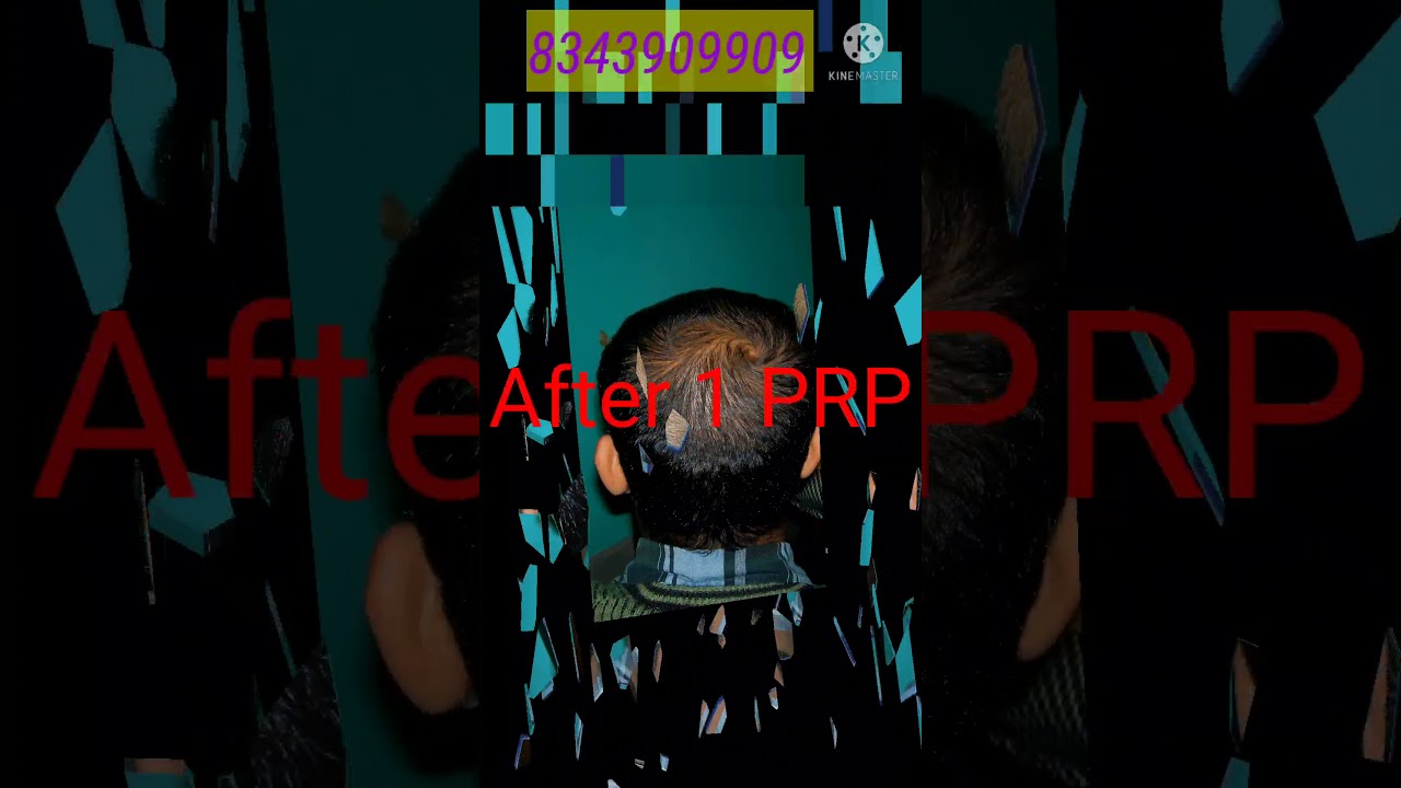 PRP Hair Loss Treatment Before and After | PRP results