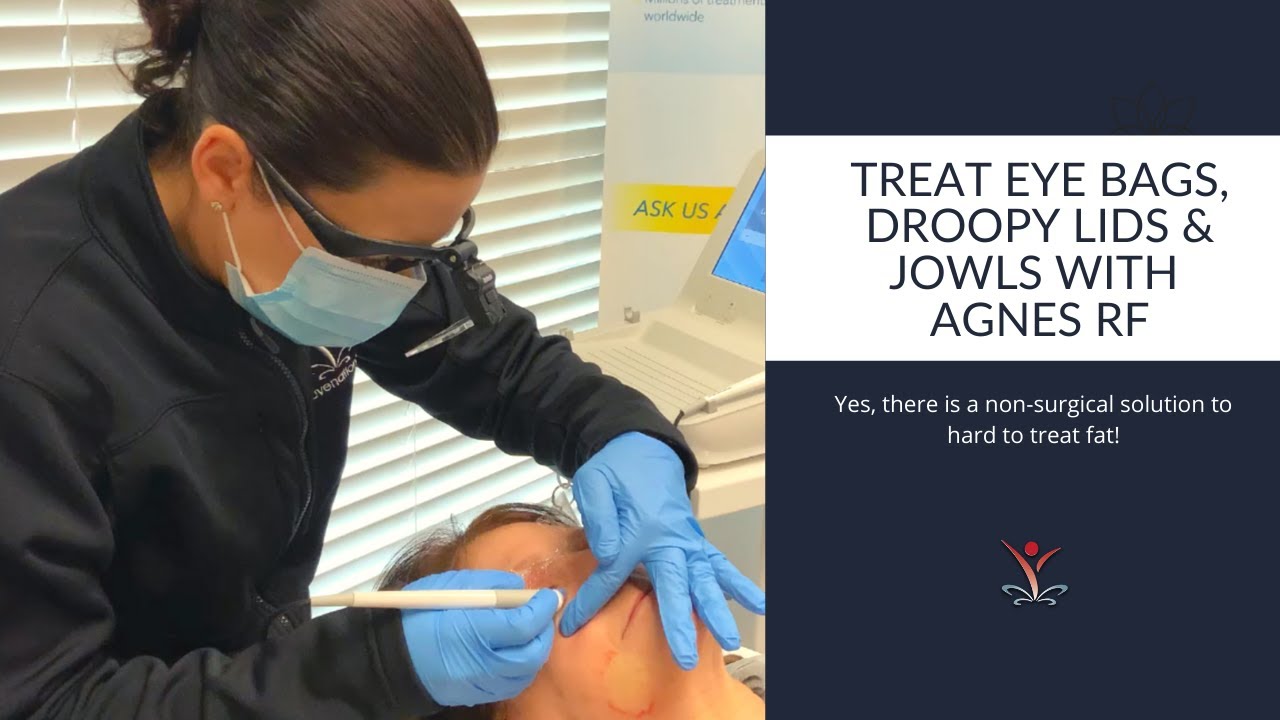 Eliminate Eye Bags & Jowls without Surgery! Meet Agnes RF.