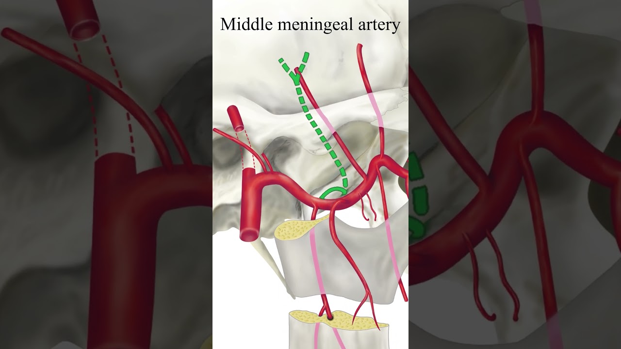 Middle meningeal artery inst