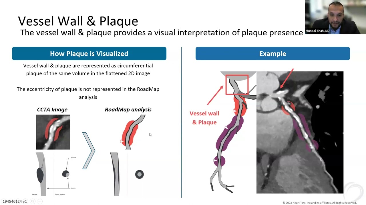 Expanding the CCTA Toolkit: The impact of anatomic visualization with the HeartFlow RoadMap analysis