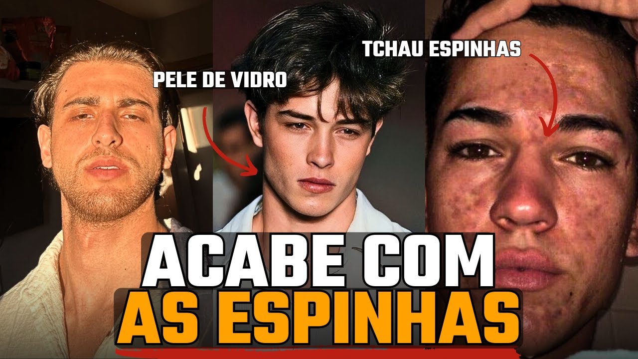COMO ACABAR COM AS ESPINHAS | COMO ELIMINAR A ACNE E DESINFLAMAR O ROSTO | COMO CUIDAR DA PELE