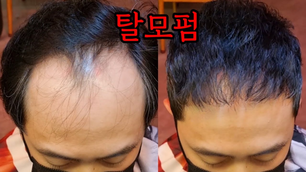 정수리 탈모 펌 |m탈모파마 |앞머리 탈모 탈모펌전문 1인미용실