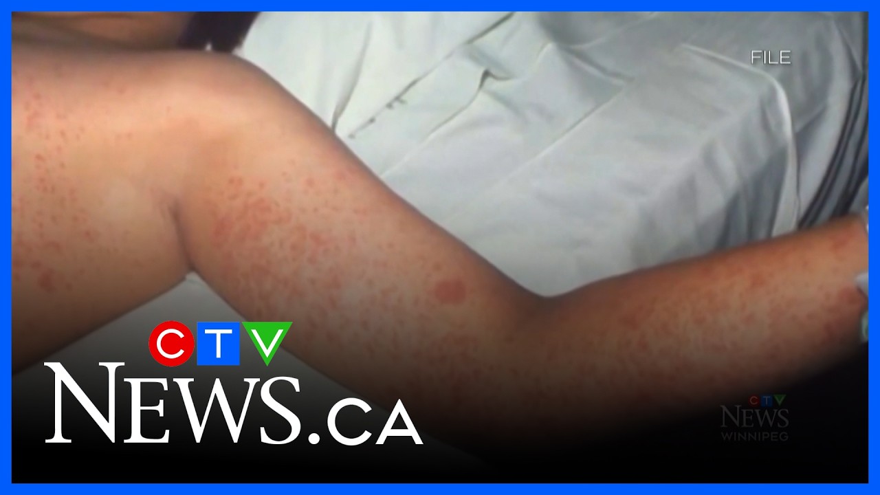 Measles cases growing in Manitoba