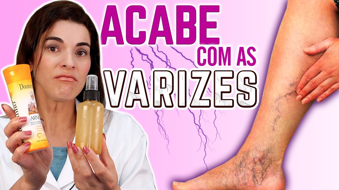 ACABE Com as VARIZES usando essa Receita e Dicas