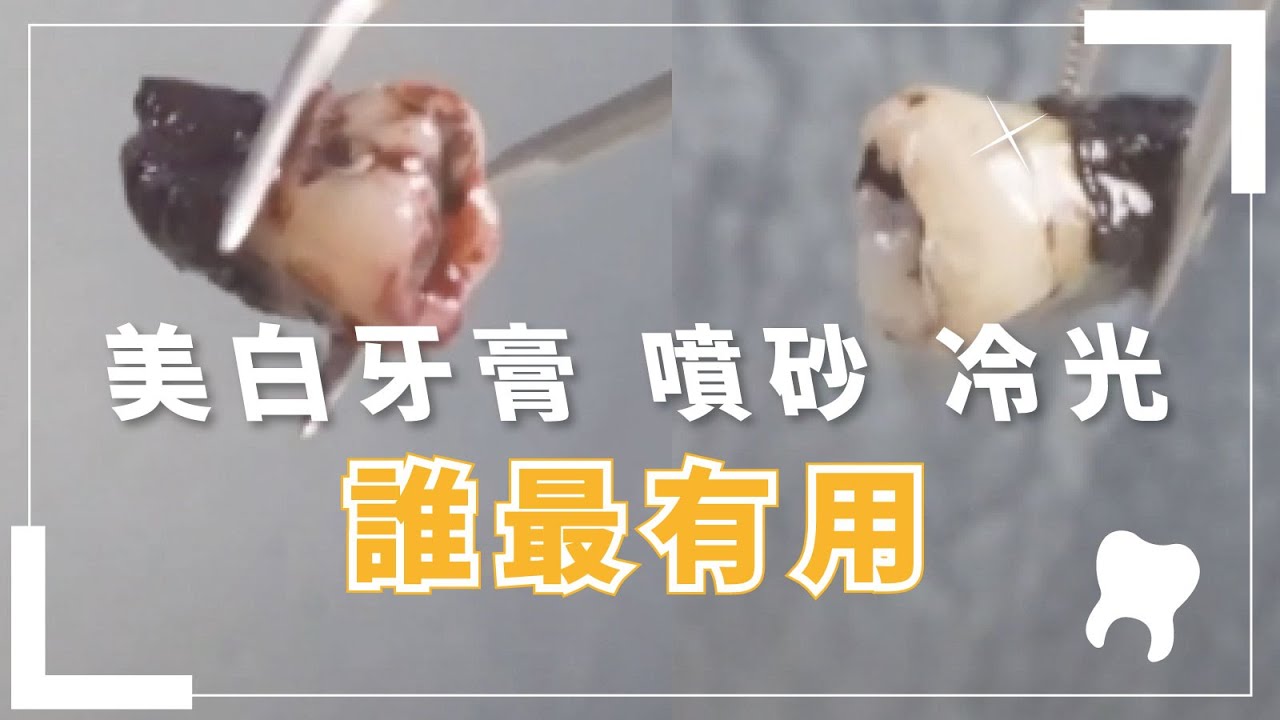 美白牙膏、噴砂、冷光美白，牙齒美白大混戰｜美齒實驗室ep.2：美白牙膏 v.s噴砂 v.s 冷光美白