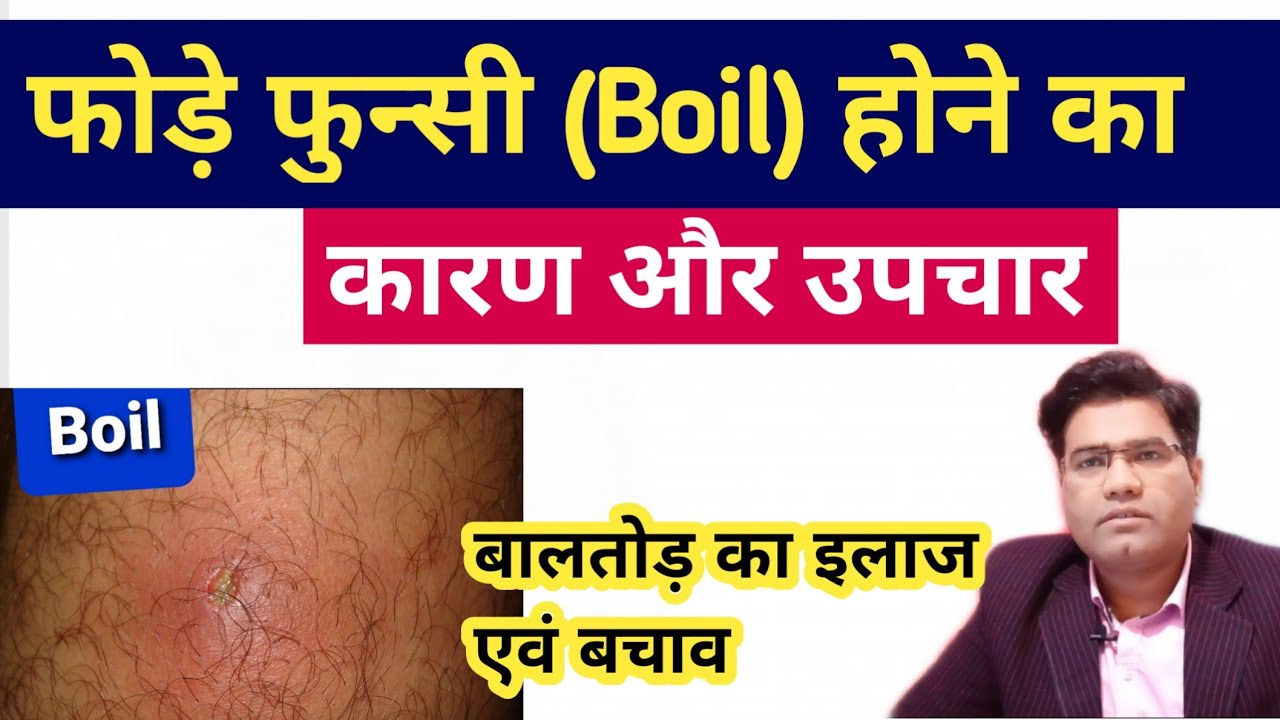How to Treat Boil At Home | What causes Boil and Preventions Methods