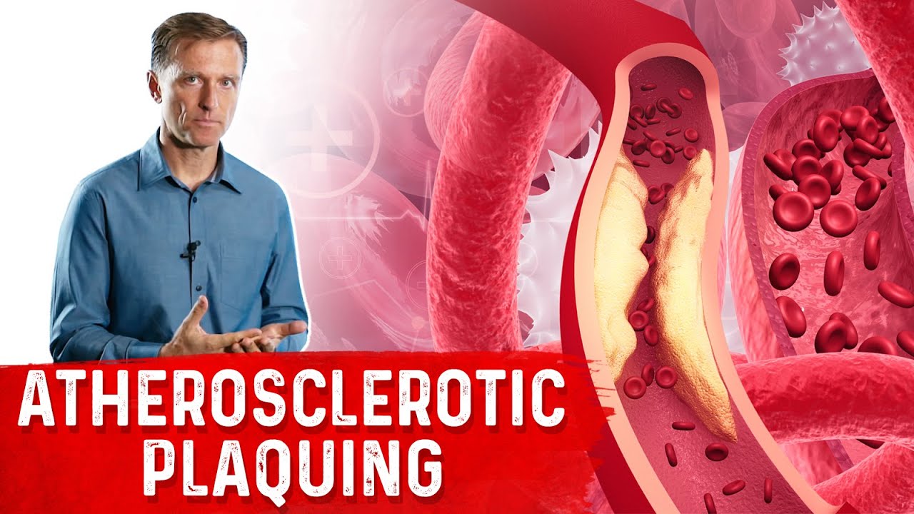 Protocol for Calcified Plaque in Your Arteries &ndash; Atherosclerosis &ndash; Dr.Berg