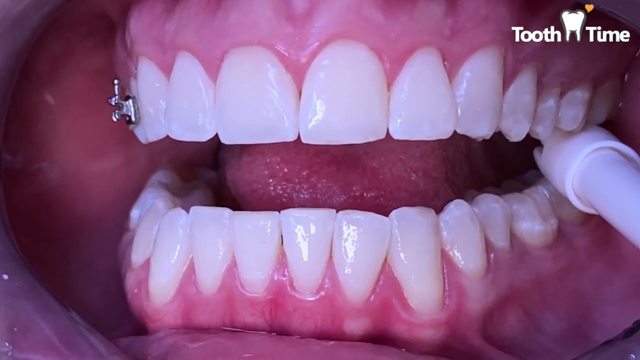 Braces Again? Why would I need braces a second time? Treating Orthodontic Relapse Tooth Time Family