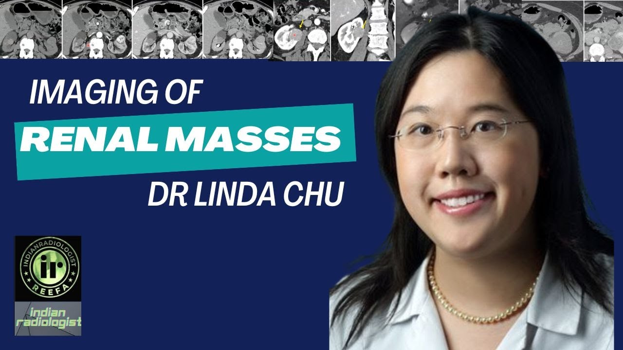 IMAGING OF RENAL MASSES | LINDA CHU | #ctbuzz