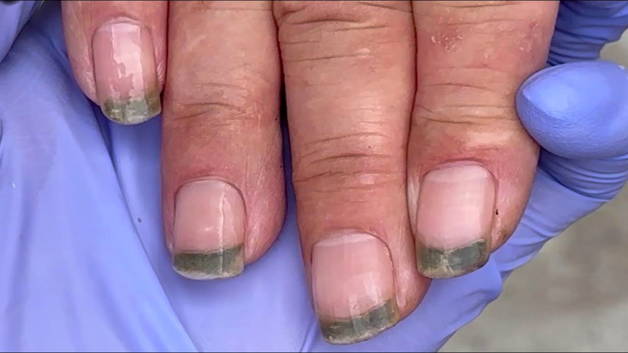 Dirty nails! There is a pile of black mud between the nails【Doctor Liu Pedicure】