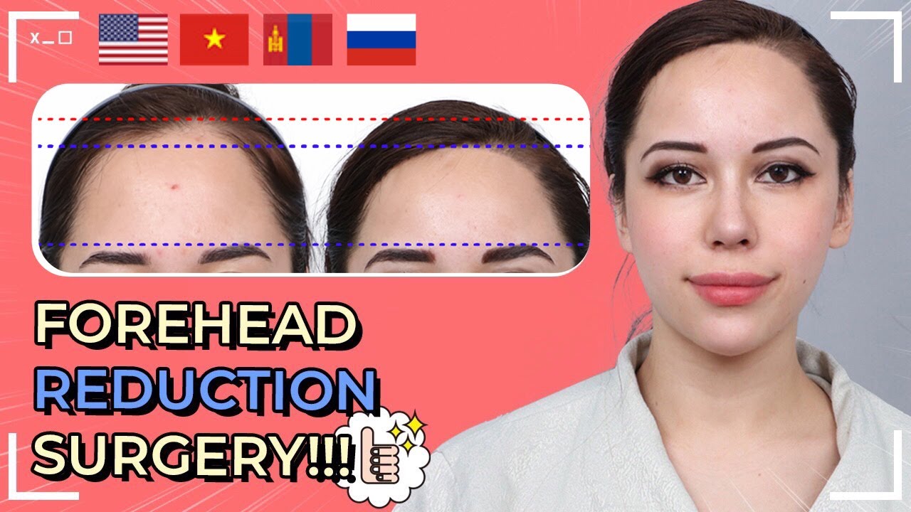 [Forehead Reduction] My Forehead Reduction Surgery in Korea, Review at DA Plastic Surgery Clinic