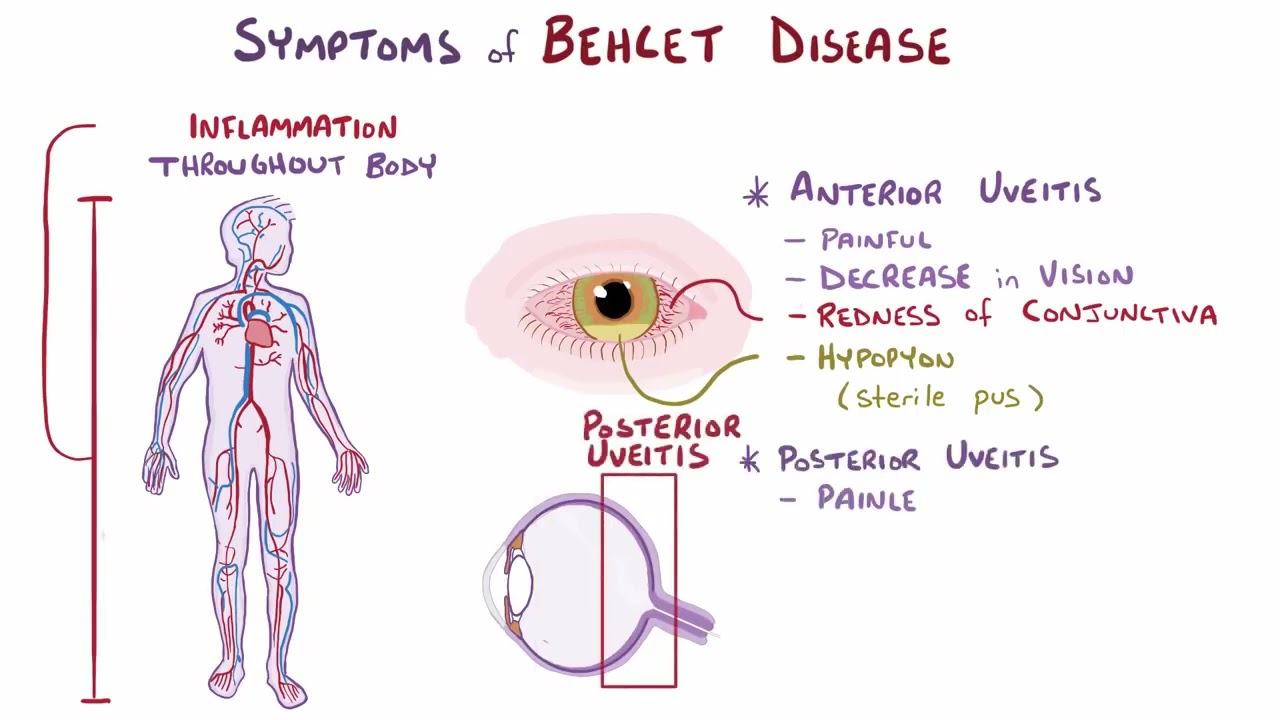 Behcet Disease | Osmosis