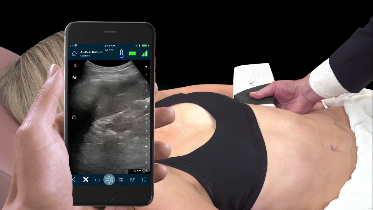 Kidney Scan by Nathaniel Reisinger | Renal Ultrasonography With Clarius Handheld Ultrasound