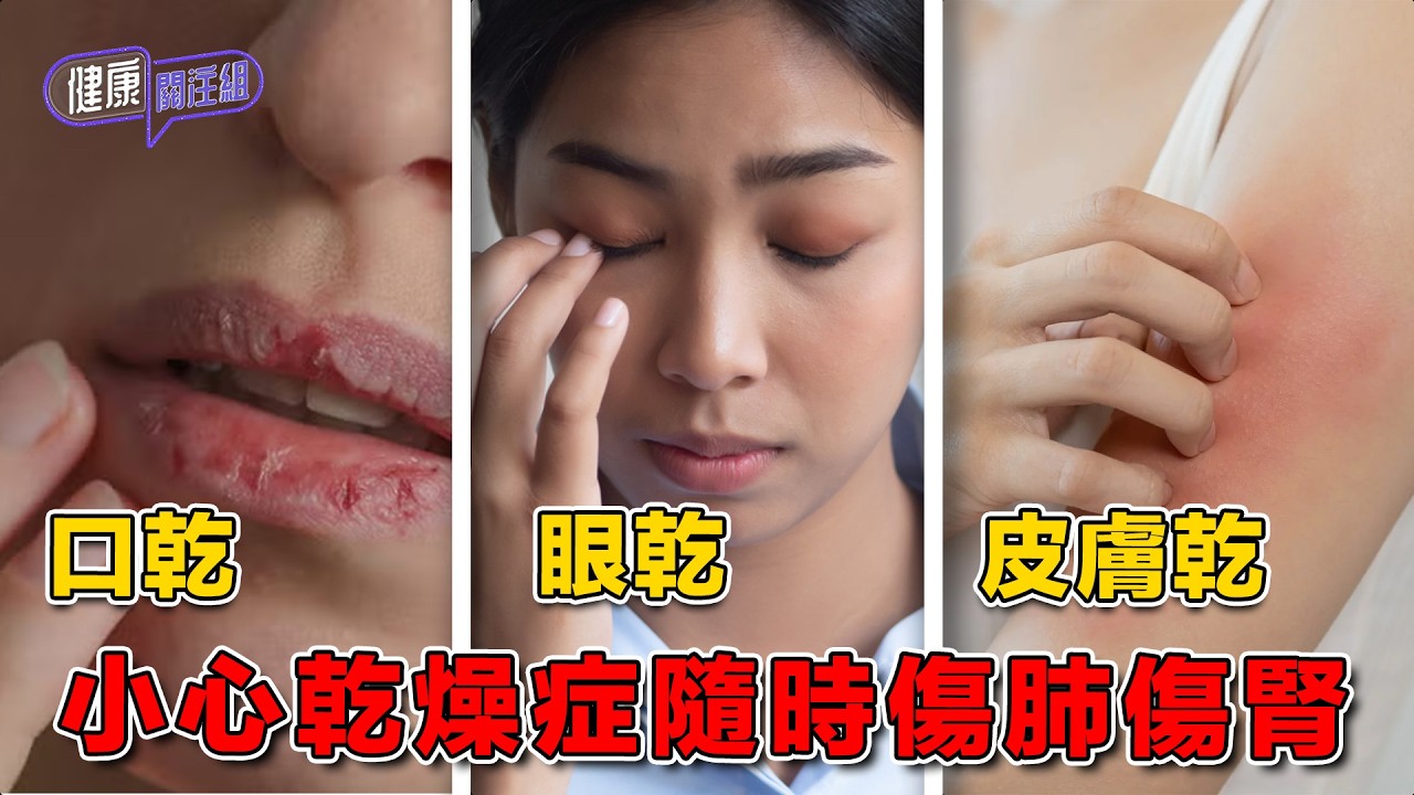 口乾 眼乾 皮膚乾 小心乾燥症隨時傷肺傷腎｜ 健康關注組 ｜ EP516 ｜ 乾燥症 ｜ 自身免疫系統 ｜ 皮膚病 ｜ 肺炎 ｜ 腎炎 ｜ 吳雲甫 ｜ 朱智賢 ｜ HOY TV 77台
