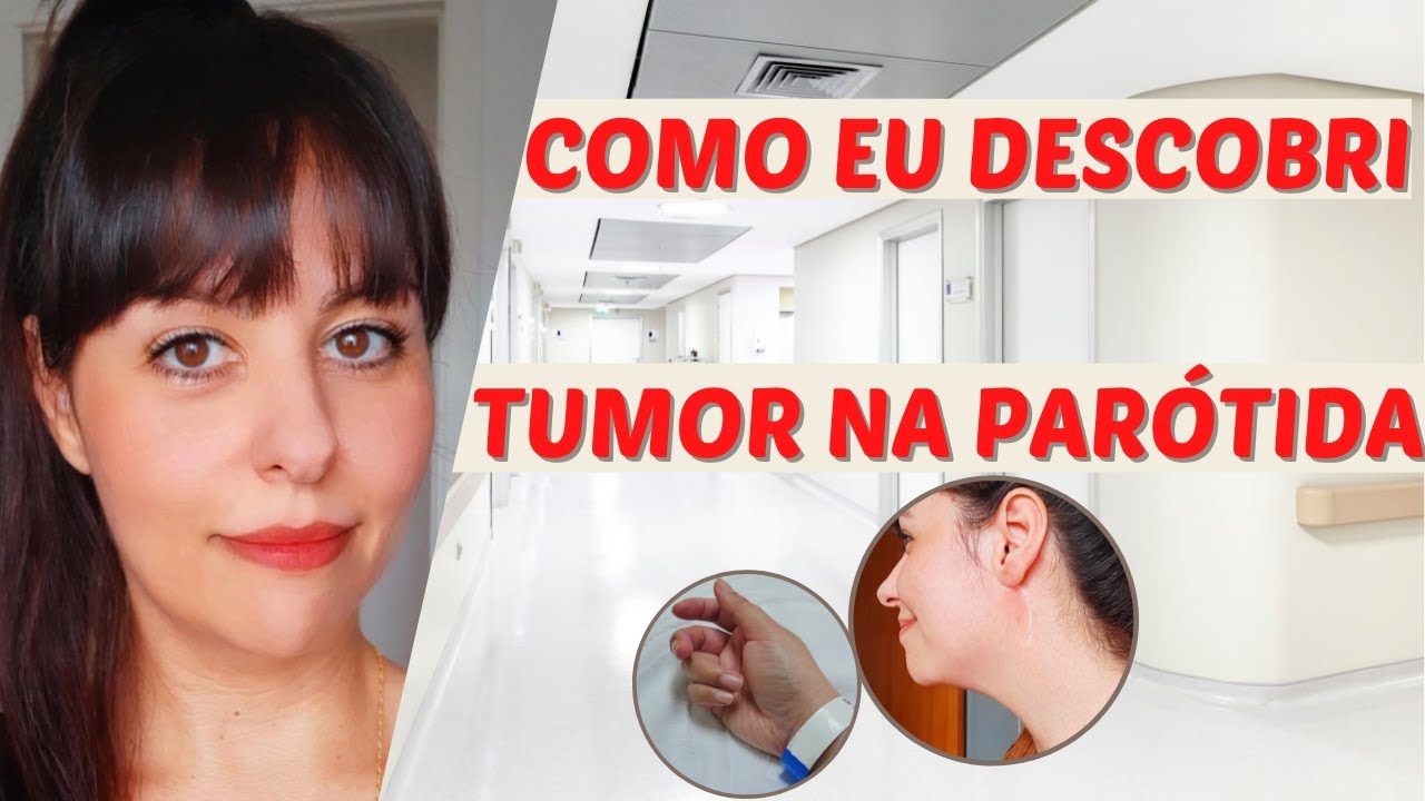 Como eu descobri meu tumor de parótida (glândula salivar)
