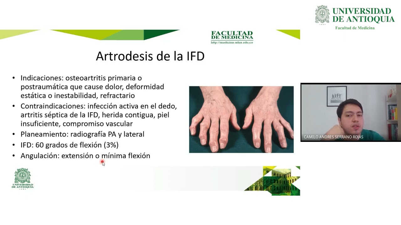 Artrodesis de la Mano y la Muñeca - Dr. Camilo Serrano