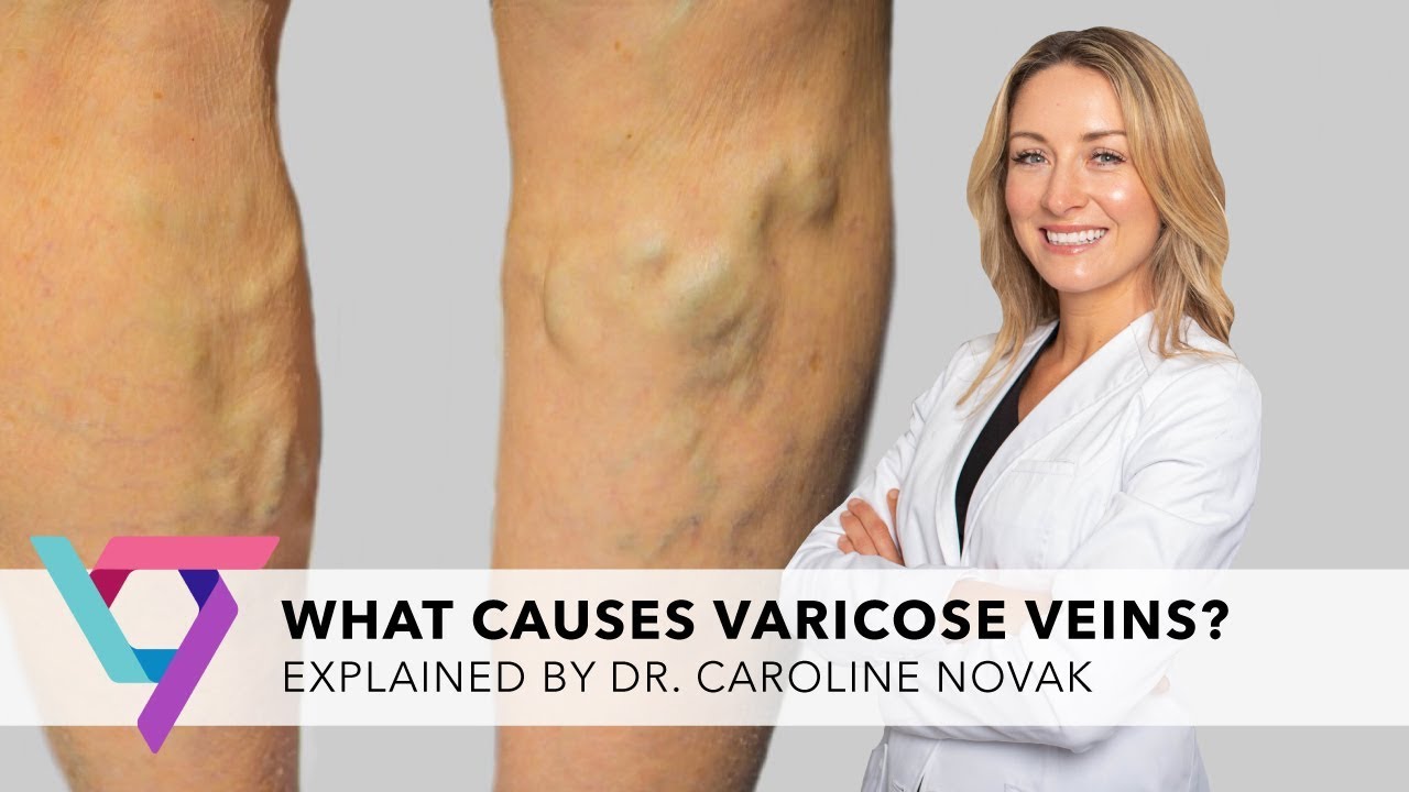 Medical Center: What Causes Varicose Veins | Top Vein Expert in New York 10016