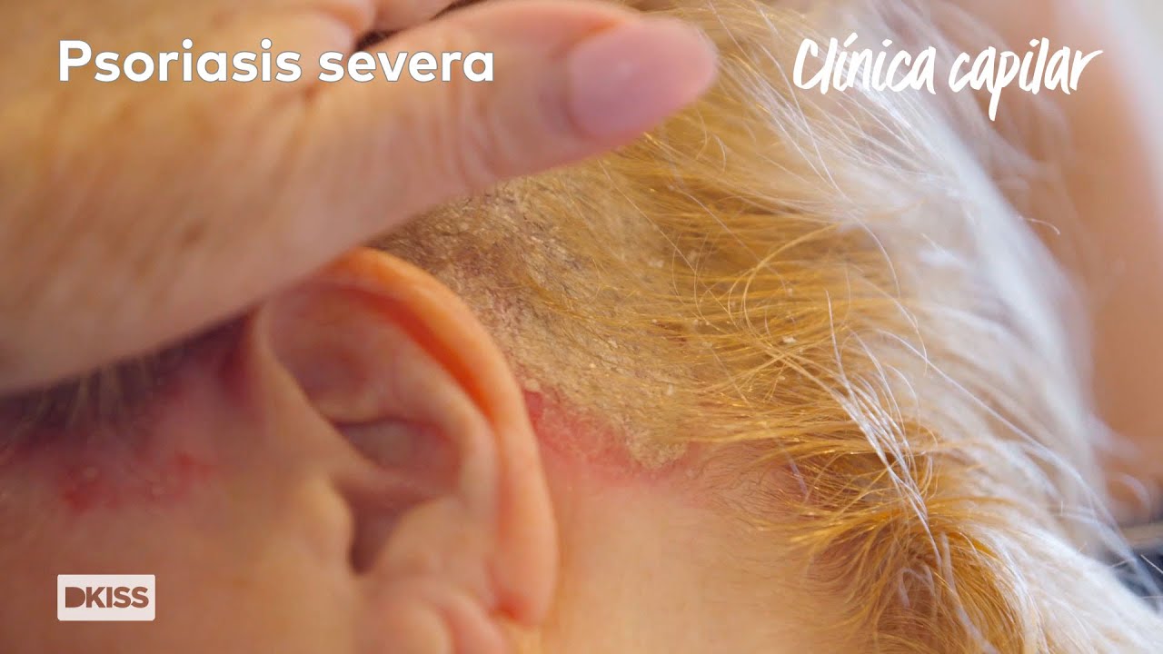 38 años con una psoriasis severa | Clínica capilar