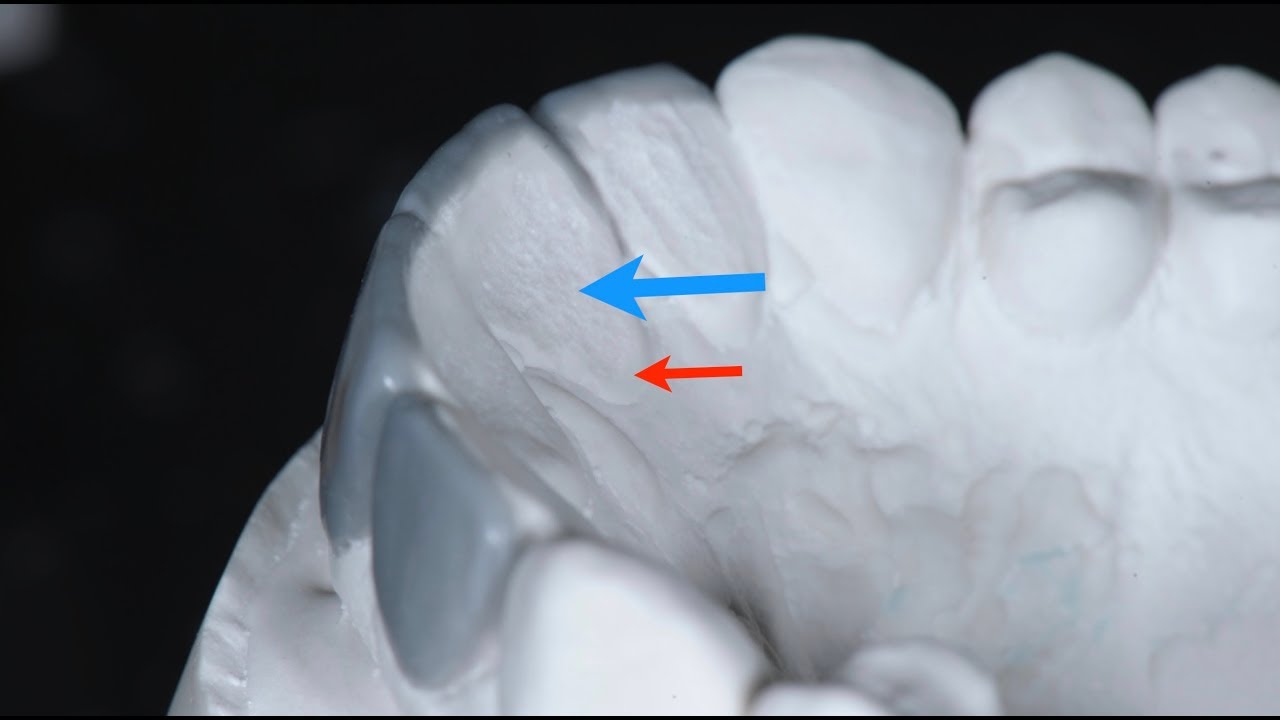 Will you not lose anterior guidance?