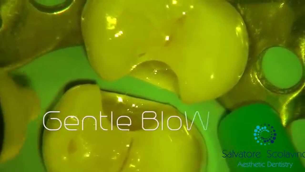 Self-Etch Adhesive System
