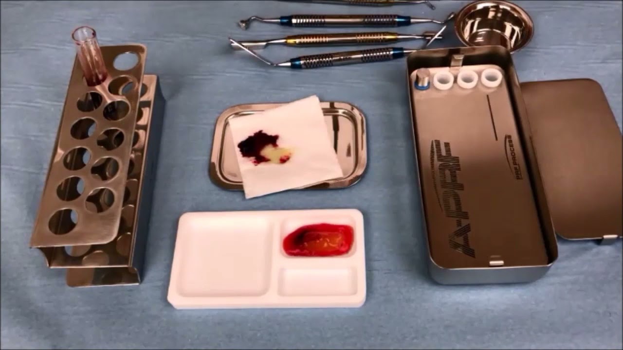 PRF Sticky Bone Technique