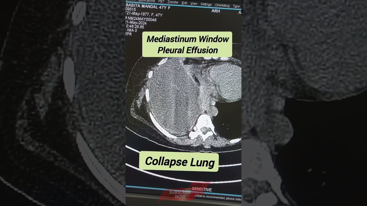 ct scan shorts video|pleural effusion in chest ct scan|collapse lung