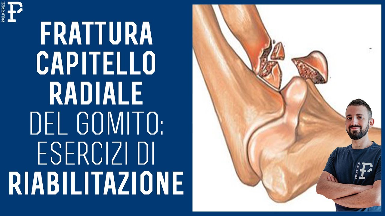 Esercizi di Riabilitazione per la Frattura del Capitello Radiale del Gomito