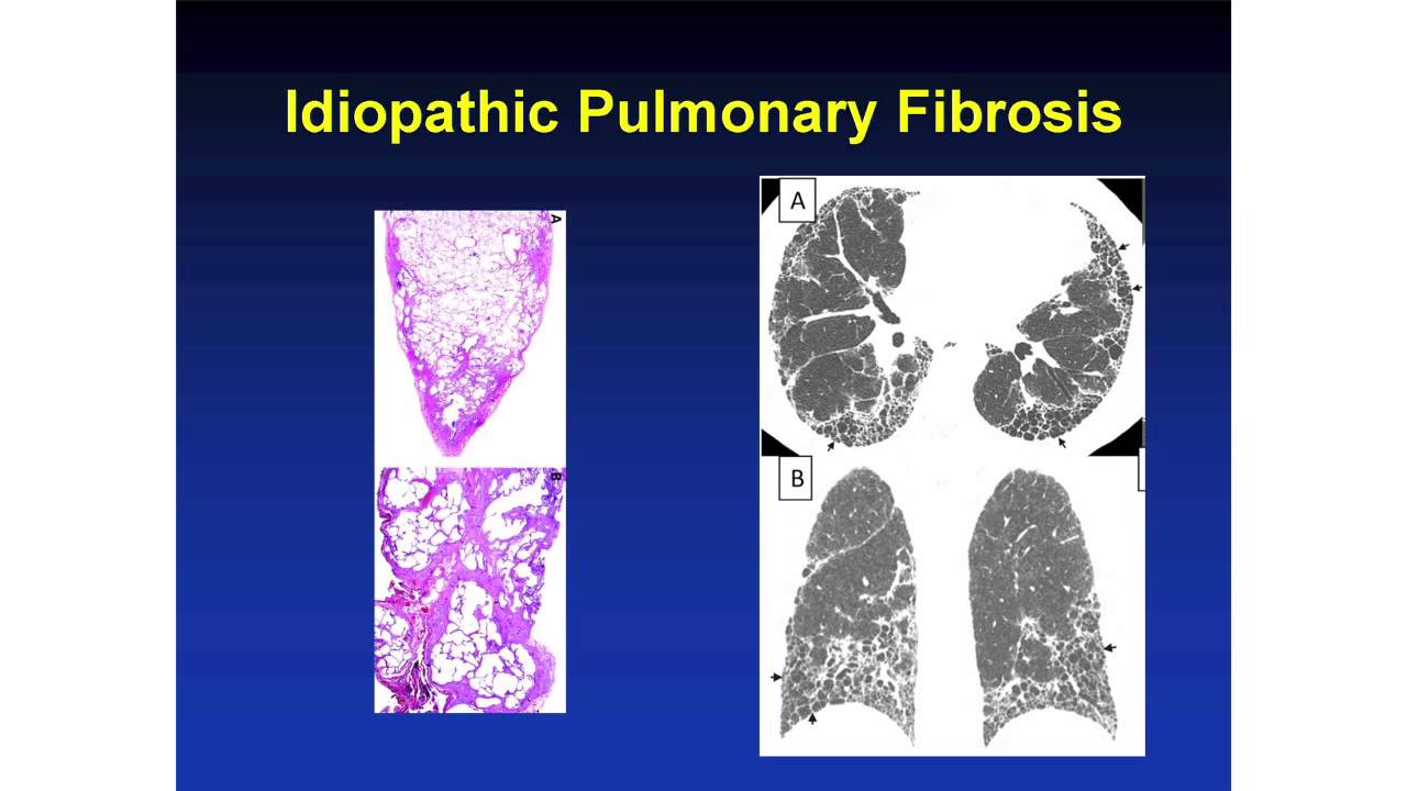 Interstitial Lung Disease in Scleroderma