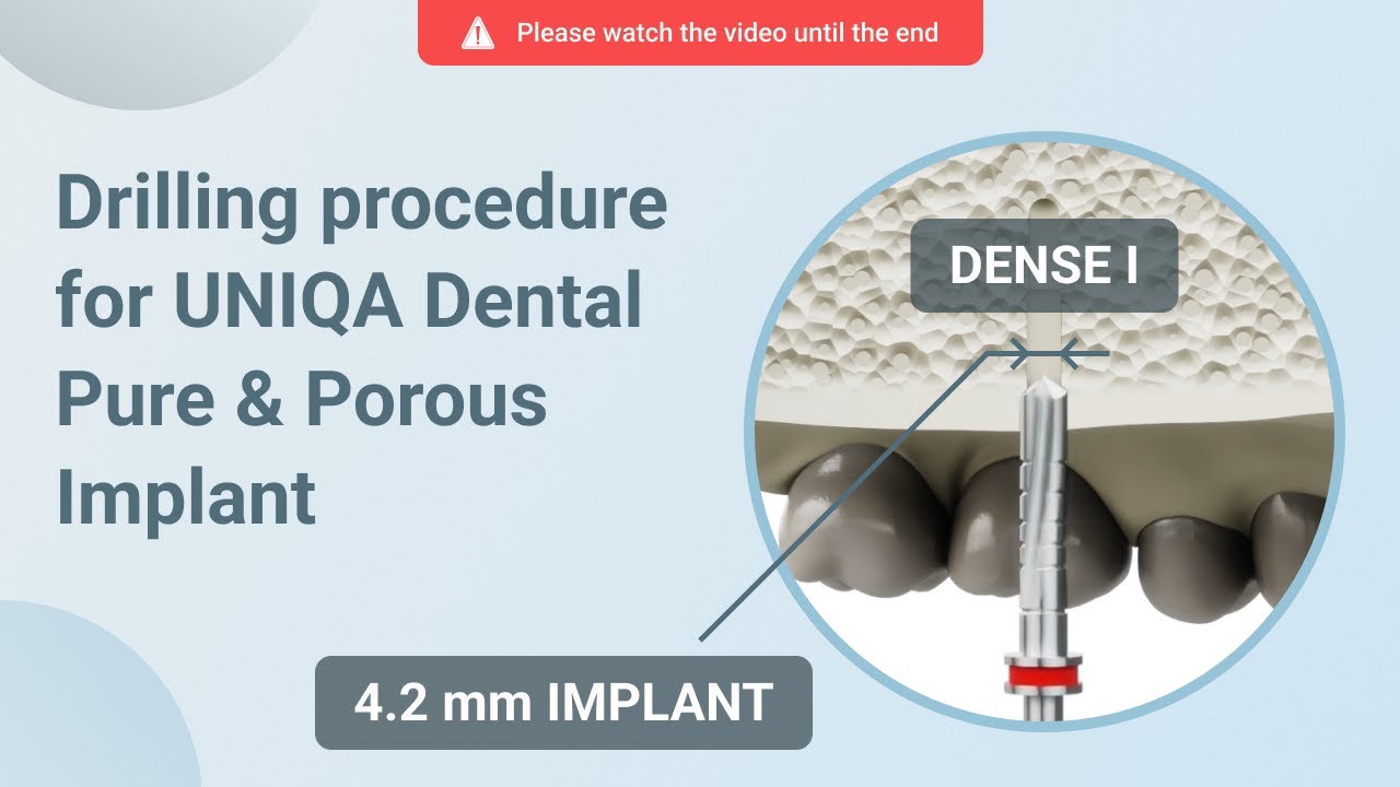 Drilling procedure for UNIQA Dental Pure & Porous Implant UH8 UV11 [ 4.2 mm | D1 bone density ]
