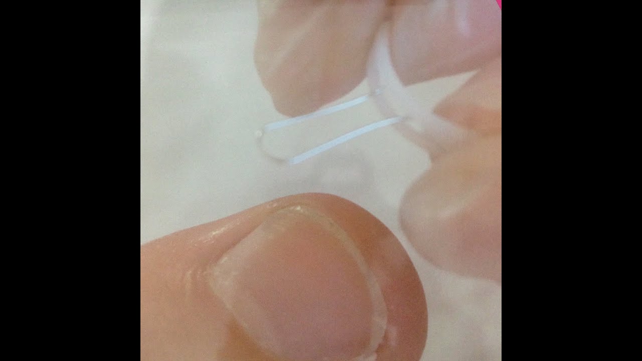 טיפול בציפורן חודרנית-podofix and COMBIped. 3to-Spange