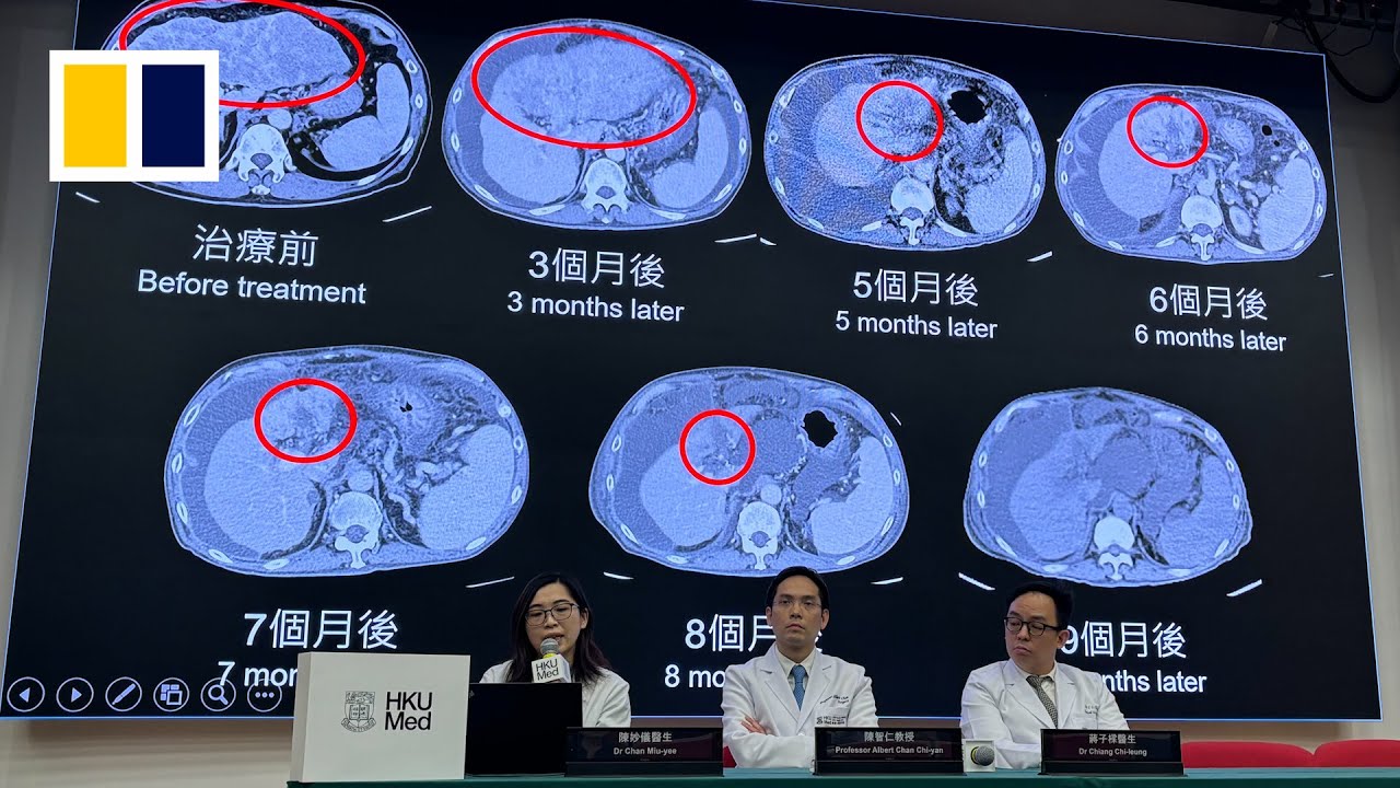‘World’s first’ treatment said to reverse stage-four liver cancer